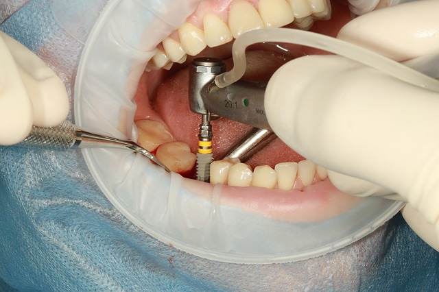 implanty zębów kraków